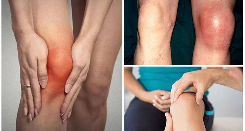 Подагра коленного сустава симптомы и лечение фото Новости