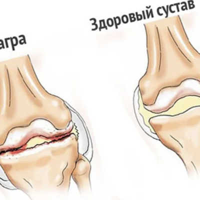 Подагра коленного сустава симптомы и лечение фото Терапевт Блог knopka.kz - гипермаркеттегі тегін жарнамалар