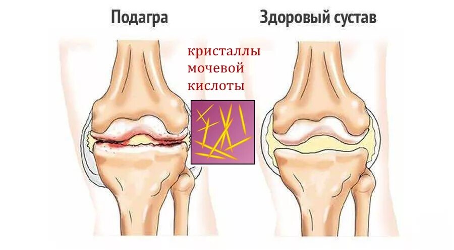 Подагра коленного сустава симптомы и лечение фото Болит коленная чашечка: причины и лечебные меры