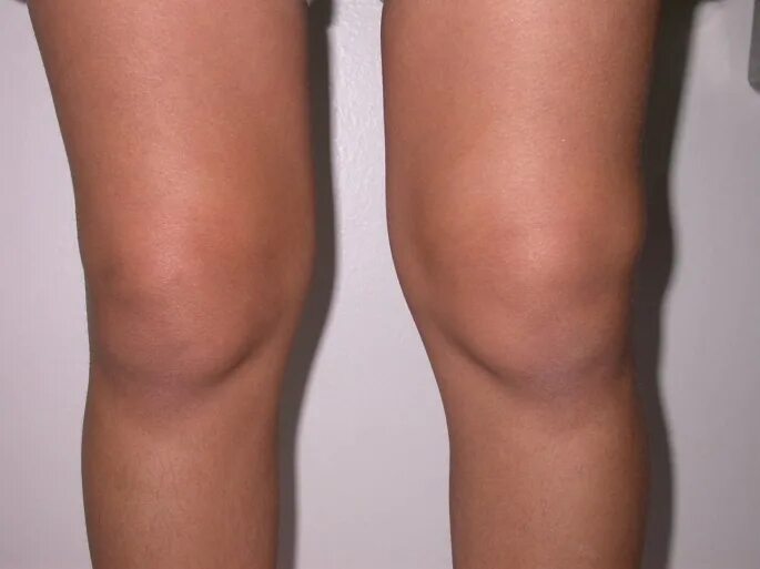 Подагра коленного сустава симптомы и лечение фото Rhupus arthropathy as the presenting manifestation in Juvenile SLE: a case repor