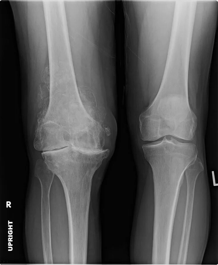 Подагра коленного сустава симптомы и лечение фото Severe Arthritis In Knee