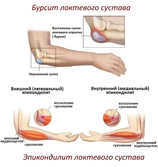 Подагра локтевого сустава симптомы и лечение фото Воспаление локтевого сустава: причины, симптомы и лечение