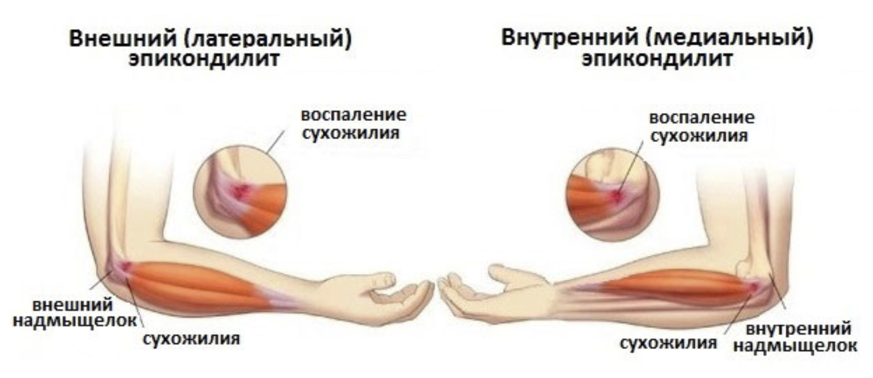 Подагра локтевого сустава симптомы и лечение фото Последствия эпикондилита: воспаление и лечение болезни