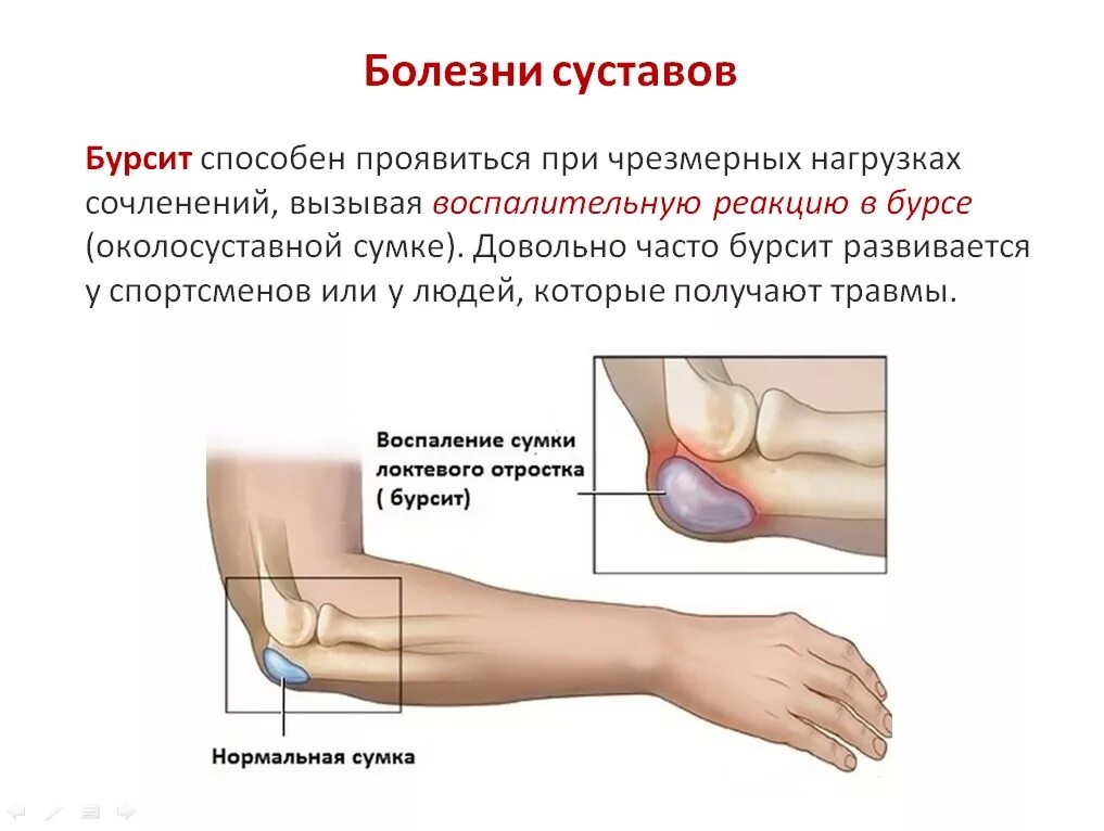 Подагра локтевого сустава симптомы и лечение фото Локтевой бурсит лечение мази: найдено 77 картинок