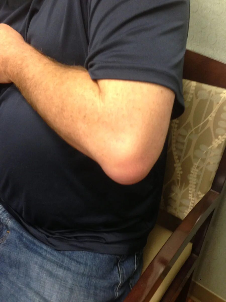 Подагра локтевого сустава симптомы и лечение фото Olecranon Bursitis Dr Geier