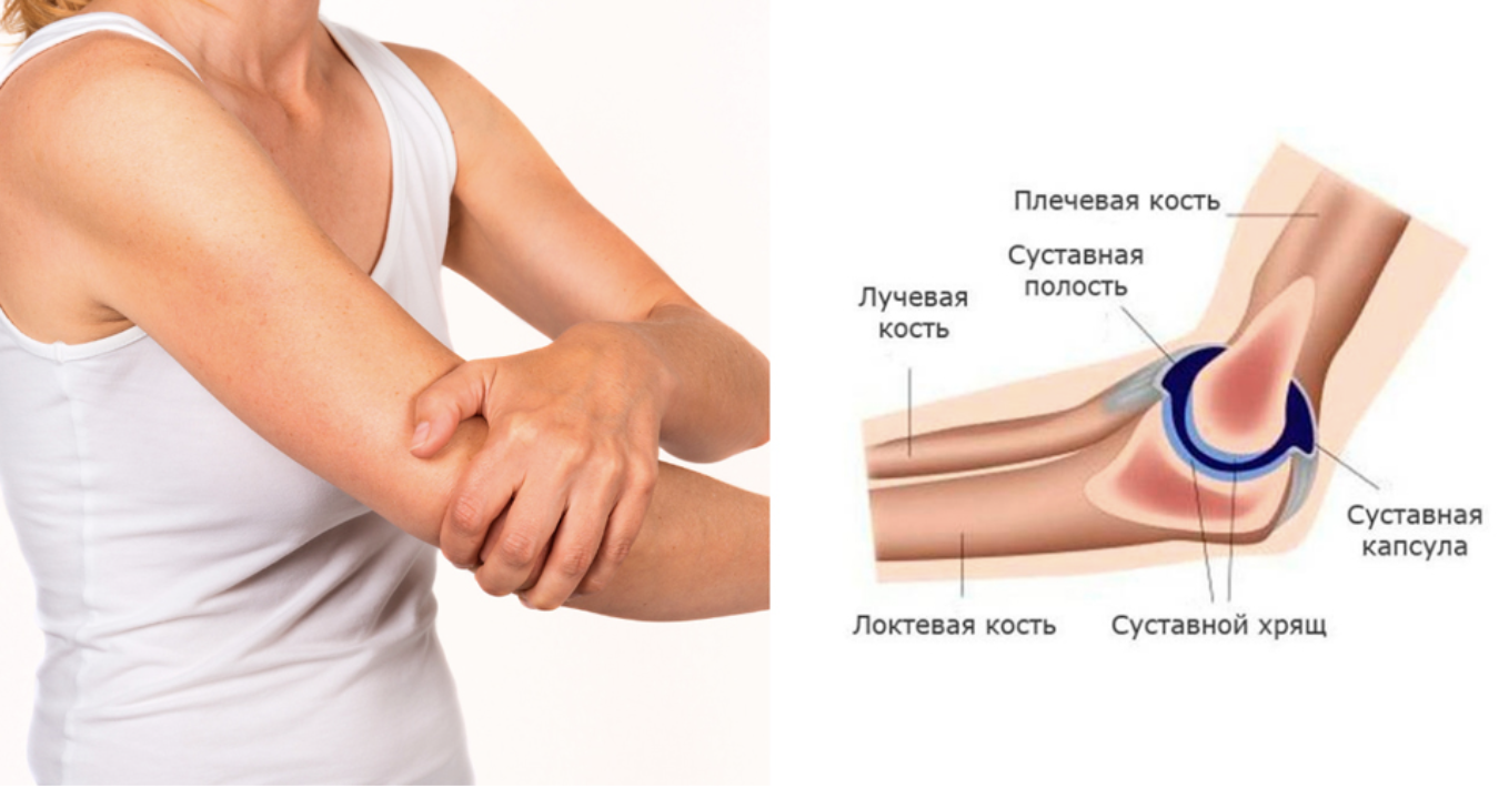 Подагра локтевого сустава симптомы и лечение фото Артрит локтевого сустава: причины, симптомы и лечение