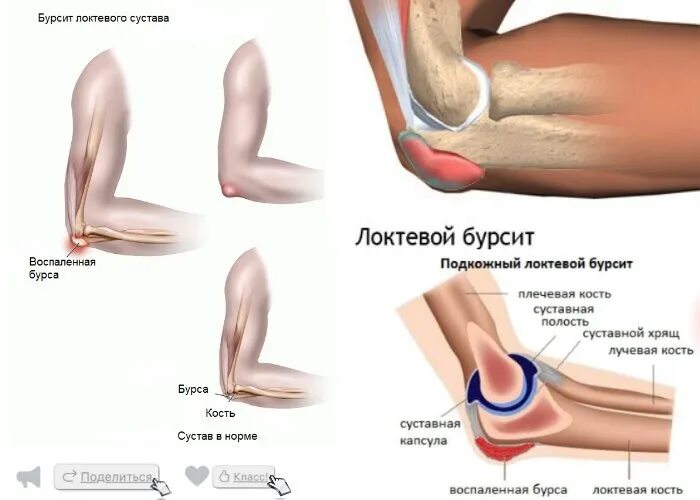 Подагра локтевого сустава симптомы и лечение фото Бурсит локтевого сустава: что это, симптомы, лечение, что делать