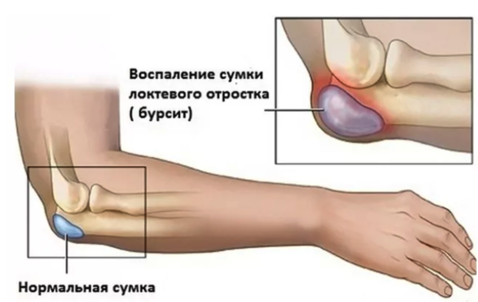 Подагра локтевого сустава симптомы и лечение фото Бурсит локтевого сустава: причины, симптомы и лечение