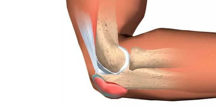 Подагра локтевого сустава симптомы и лечение фото Bursitis of the elbow joint - photos, symptoms and treatment, drugs