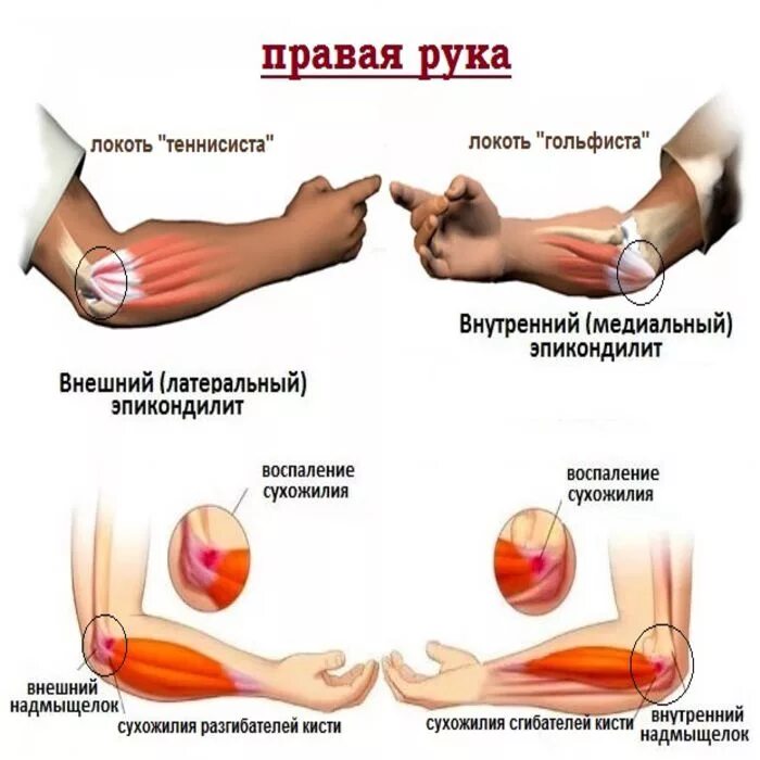 Подагра локтевого сустава симптомы и лечение фото Эпикондилит или локоть теннисиста: симптомы, лечение - Доктор Позвонков