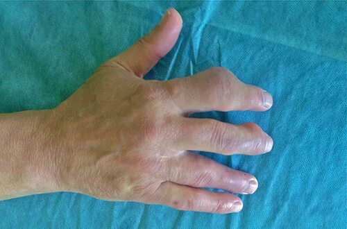 Подагра на руках фото Случаи из практики - Part 2 HANDCLINIC.PRO