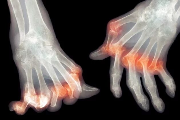 Подагра на руках фото лечение Researchers target suppressive cells to keep the body from attacking itself. Aut