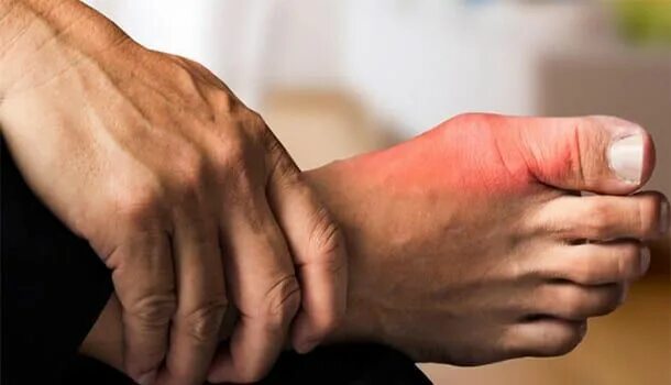 Подагра на руках фото лечение Pin on Gout