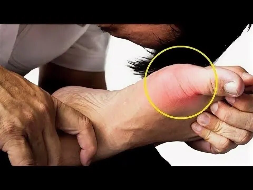 Подагра на руках фото лечение Pin on Tips