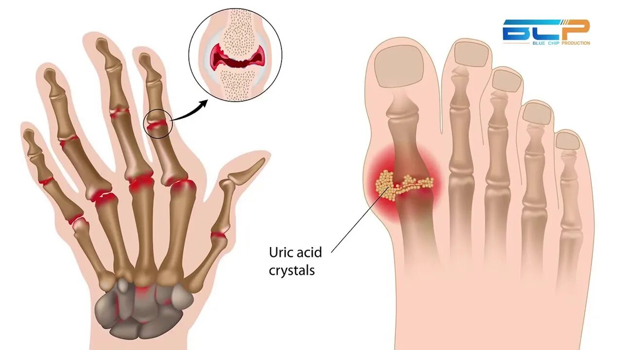 Подагра на руках фото лечение Reasons for high Uric acid - YouTube