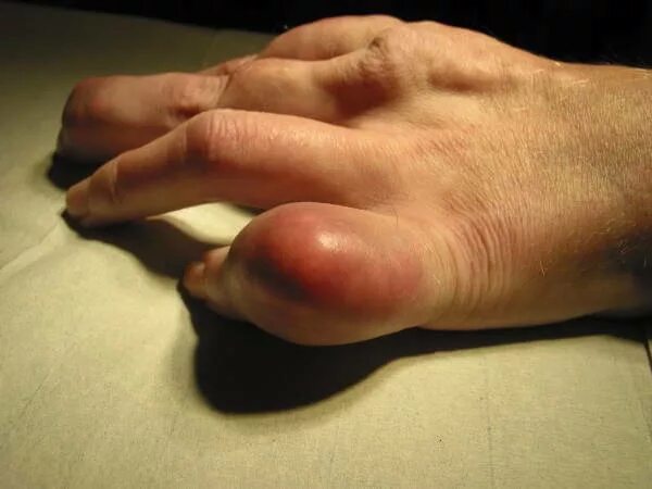 Подагра на ушах фото Psoriasis - home treatment