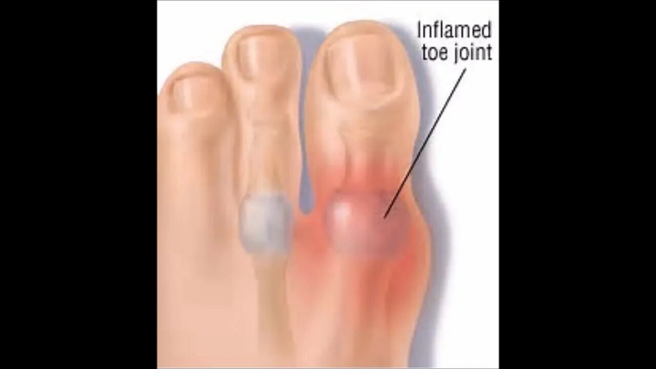 Подагра на ушах фото Signs And Symptoms Of Acute Gouty Arthritis - YouTube