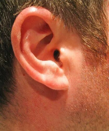 Подагра на ушах фото Ear - Right - 104/365 Ear cleaning wax, Ear wax removal, Cleaning ears with pero