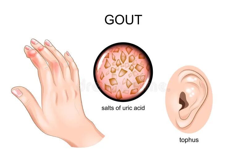 Подагра на ушах фото Gout, arthritis, tofus. stock vector. Illustration of acid - 114358324