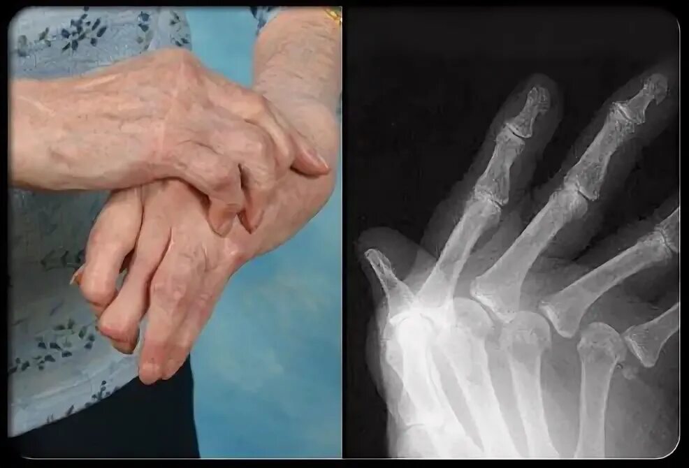 Подагра признаки фото руки Joint X-rays can also be helpful in monitoring the progression of rheumatoid dis