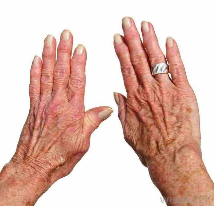 Подагра признаки и лечение фото руки Pin on Arthritis Treatment