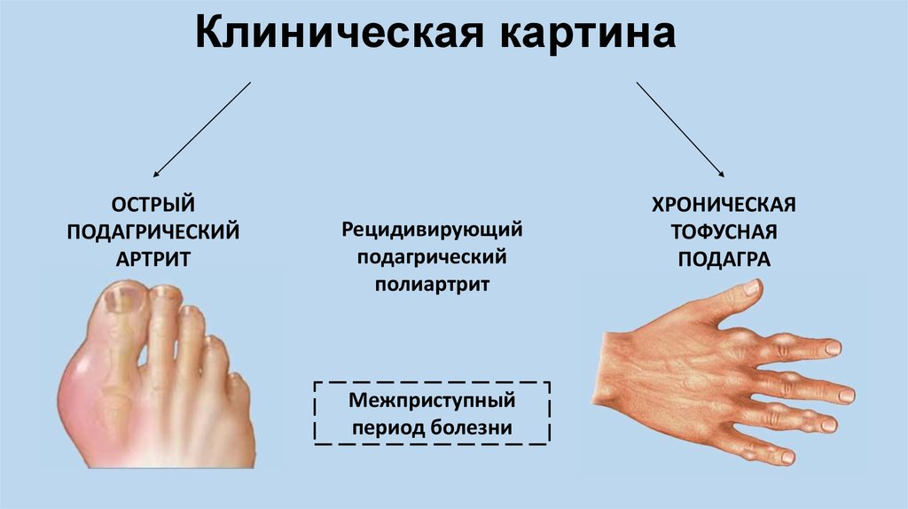Подагра признаки и лечение фото руки Диета при подагре: как правильно питаться при подагре? Клиника Гевди Дзен