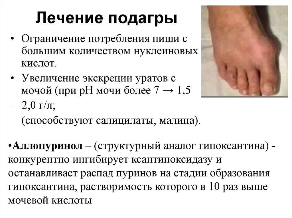 Подагра признаки и лечение фото руки Подагра что это и лечения