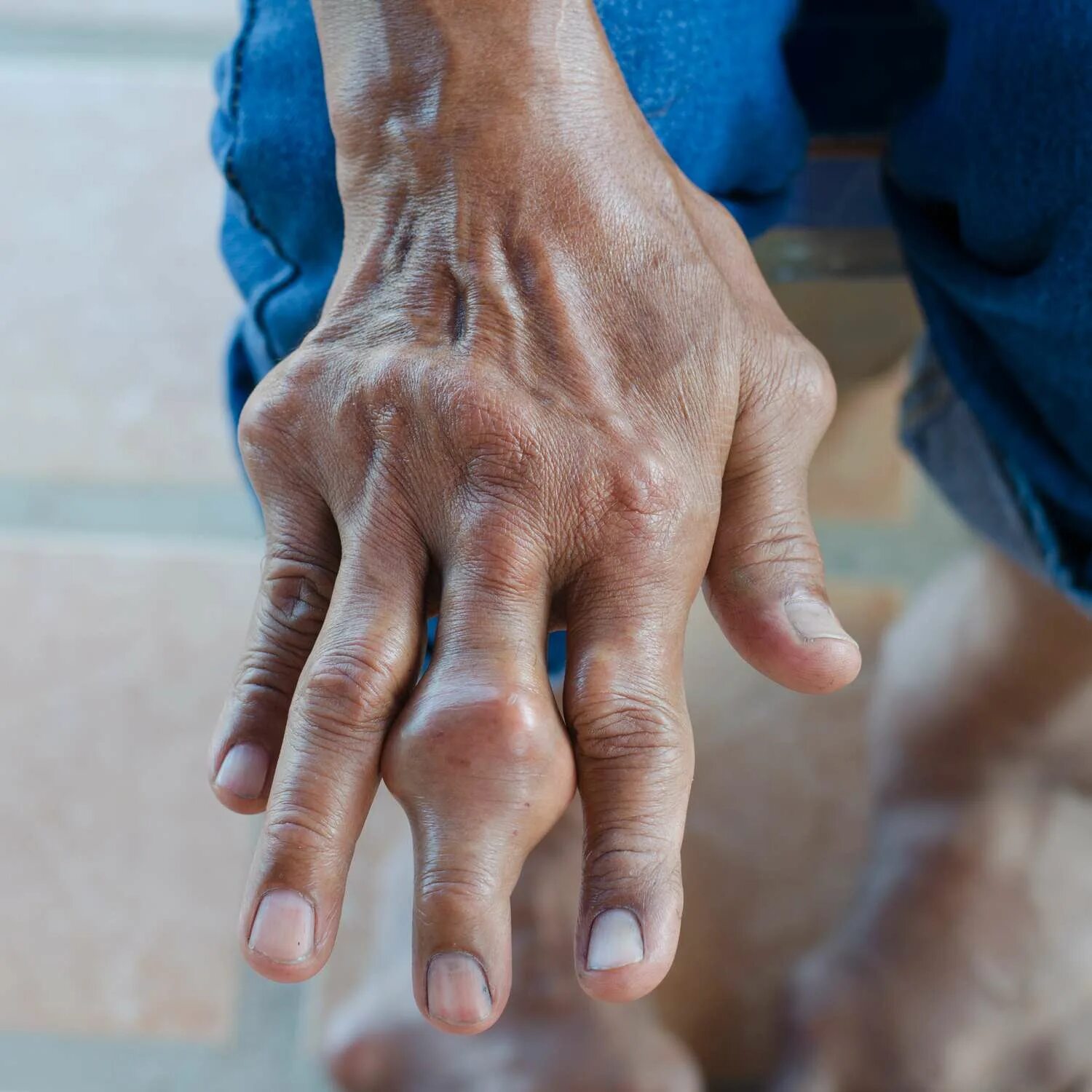 Подагра признаки и лечение фото руки Gout in the Fingers: Symptoms, Pictures, and Treatment