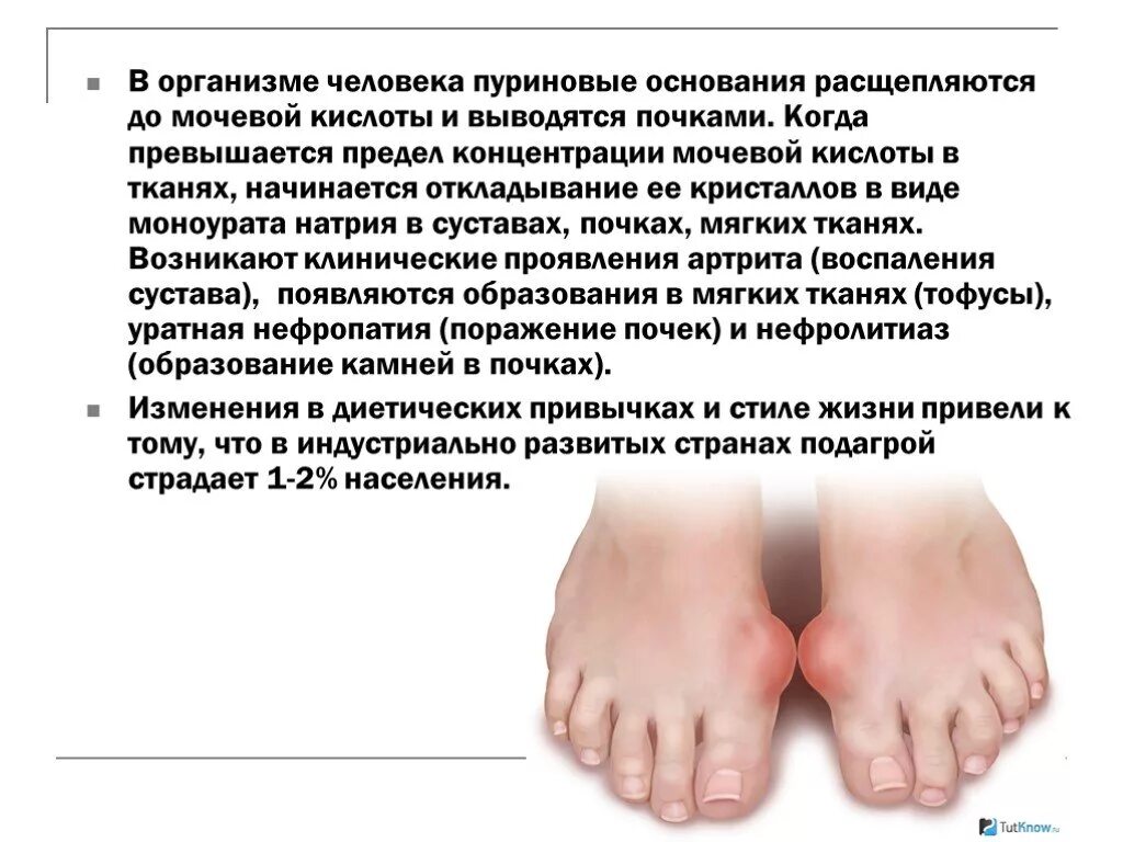 Подагра признаки начальная стадии фото Картинки ПОДАГРА СИМПТОМЫ И ЛЕЧЕНИЕ У ЖЕНЩИН 60