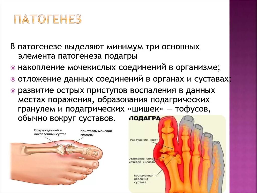 Подагра признаки начальная стадии фото Периоды подагры