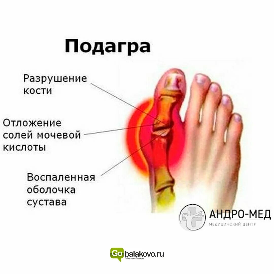 Подагра признаки начальная стадии фото Лечение боли в суставе большого пальца