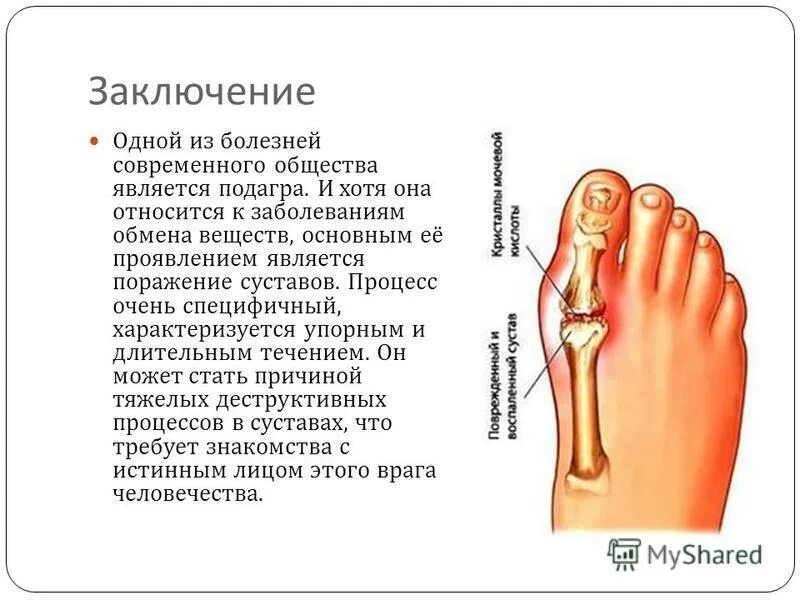 Подагра признаки начальная стадии фото Острый Подагрический Артрит - Buy-artox.ru
