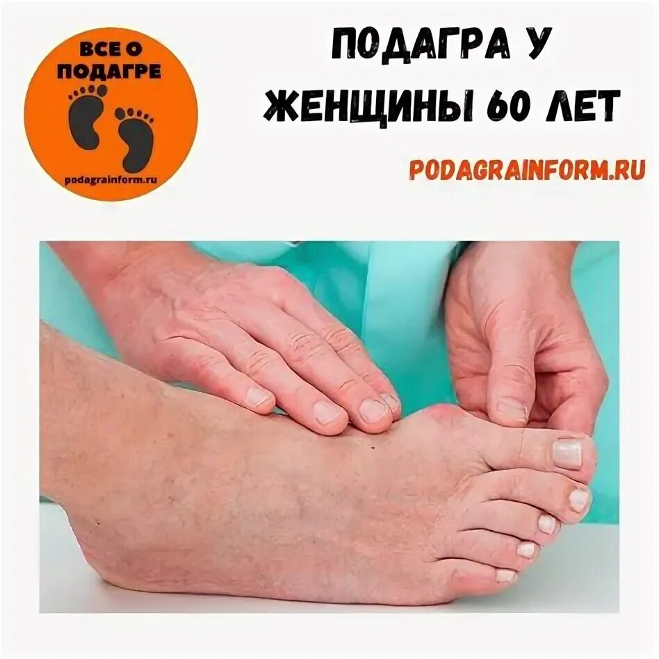 Подагра признаки у женщин на руках фото Признаки подагры у женщин