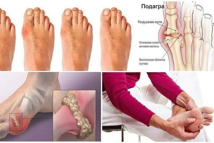 Подагра симптомы фото Подагра: когда суставы попали в капкан - МК Тверь