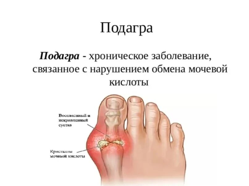Подагра симптомы фото Картинки ПОДАГРА СИМПТОМЫ И ЛЕЧЕНИЕ У ЖЕНЩИН 60