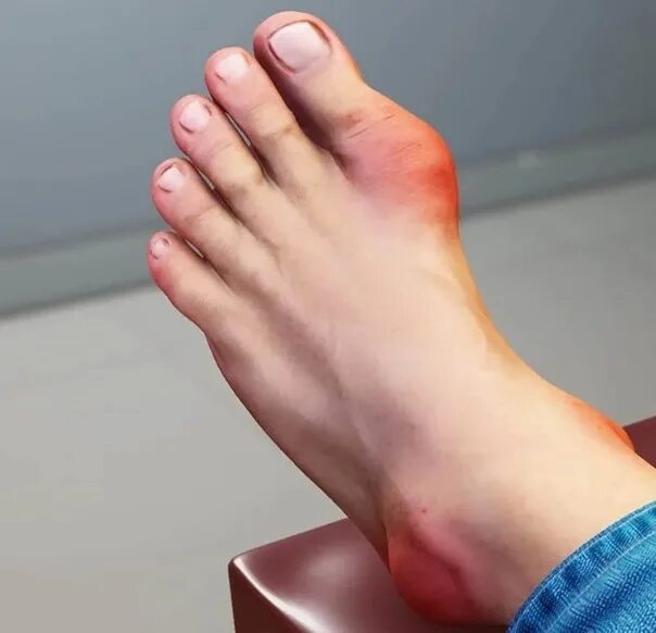 Подагра симптомы фото Orthodox conspiracy against gout: It is necessary to melt the bath well (the mai