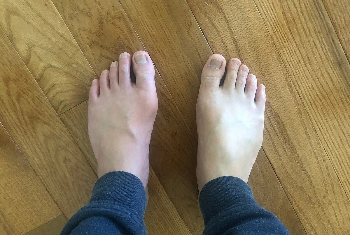 Подагра симптомы фото на ногах File:Gout Comparison.jpg - Wikipedia