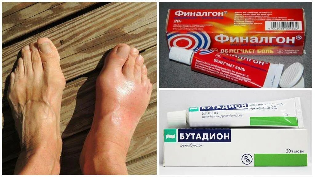 Подагра симптомы лечение фото Как снять воспаление косточек на большом пальце стопы - vashinogu