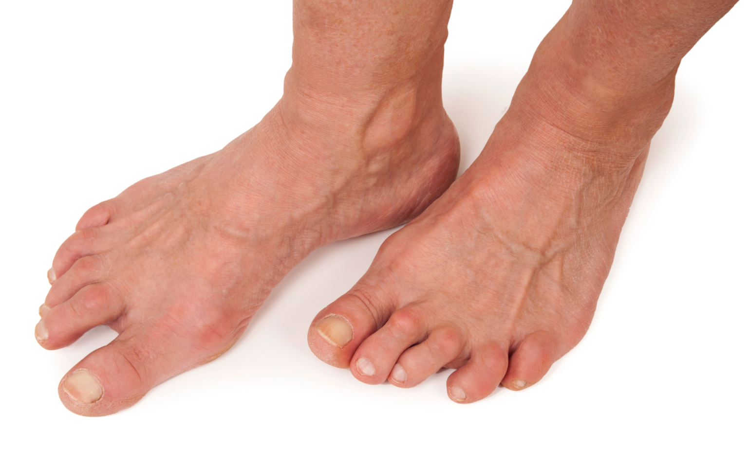 Подагра симптомы лечение фото Diabetic & Arthritis Foot Care By Steady Gait Foot Clinic in Scarborough