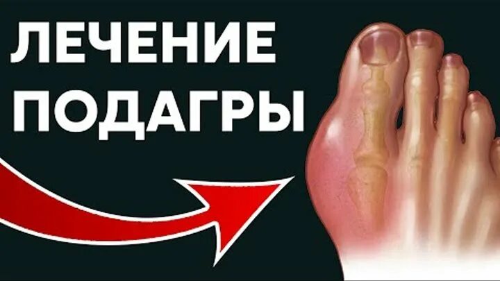 Подагра симптомы у женщин на ногах фото Наталья Лубянская(ЗыковаБаталова - Заметки OK.RU