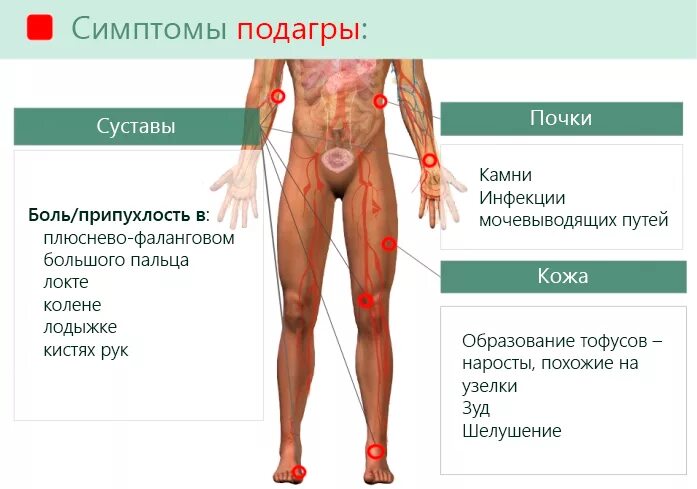 Подагра симптомы у женщин на ногах фото Подагра - причины, симптомы, диагностика и лечение