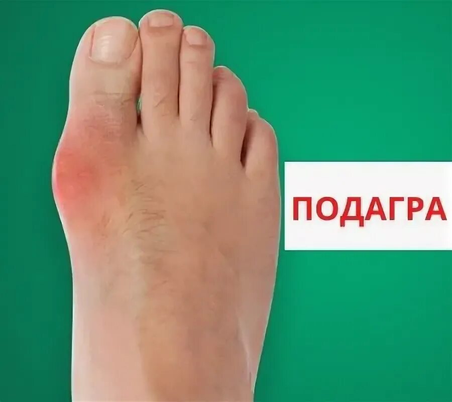 Подагра симптомы у женщин на ногах фото Подагра - причины, симптомы и лечение быстро