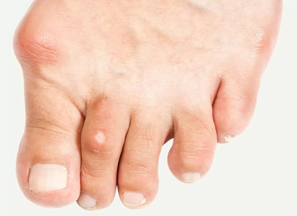 Подагра симптомы у женщин на ногах фото Bunions - Davenport House Clinic