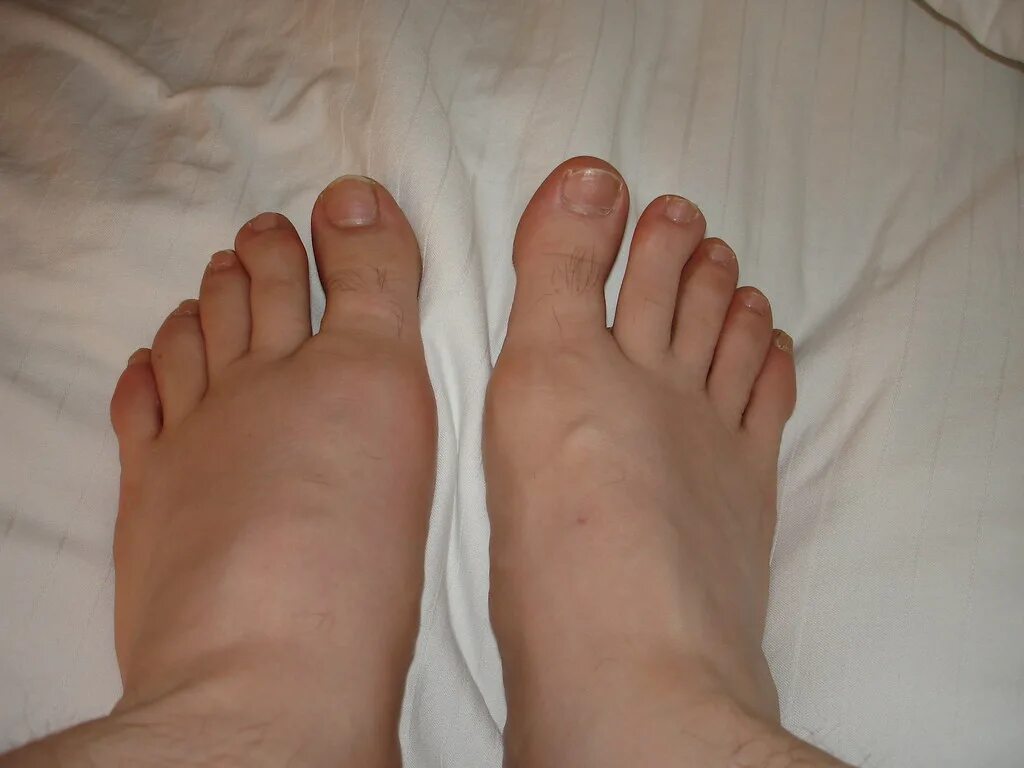 Подагра симптомы у женщин на ногах фото Gout swolen left foot Michael Sauers Flickr