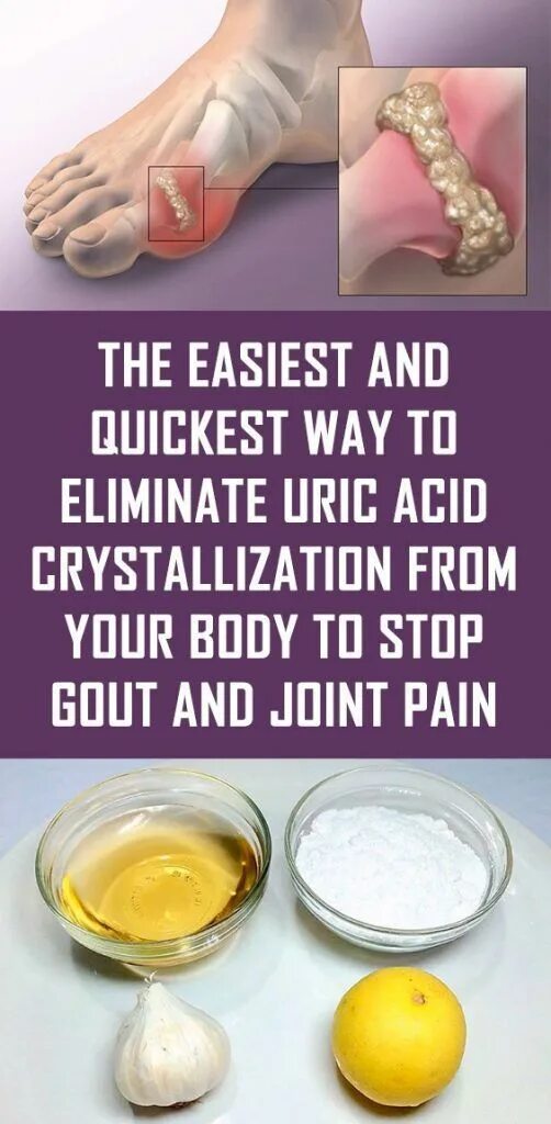 Подагра таблетки фото How to Eliminate Uric Acid From Joints #healthcare #fitness #howtoeliminate #uri
