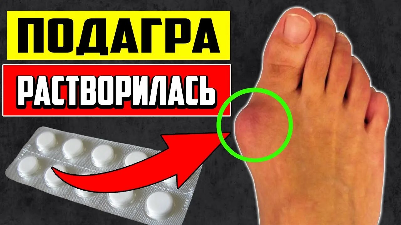 Подагра таблетки фото Эти ГЕНИАЛЬНЫЕ ТАБЛЕТКИ Рассасывают ПОДАГРУ на ногах без остатка. Подагра на сус