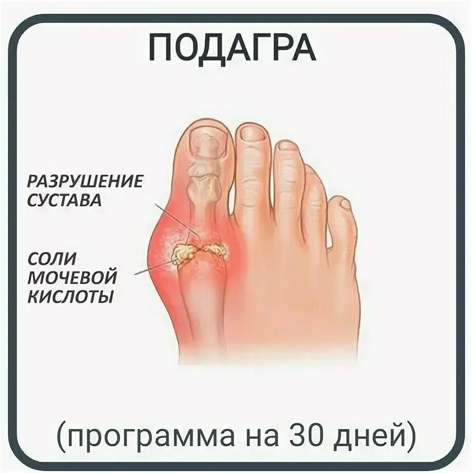 Подагра у детей симптомы и лечение фото Программа - Сұлулық пен денсаулыққа арналған тауарлар ішінде Акмолинская область