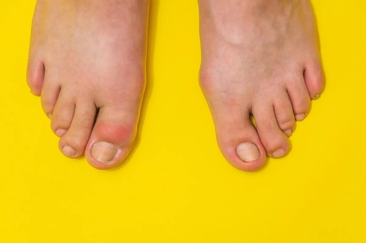 Подагра у детей симптомы и лечение фото Can Gout Be In A Bnig Toe Only Flash Sales bellady.by