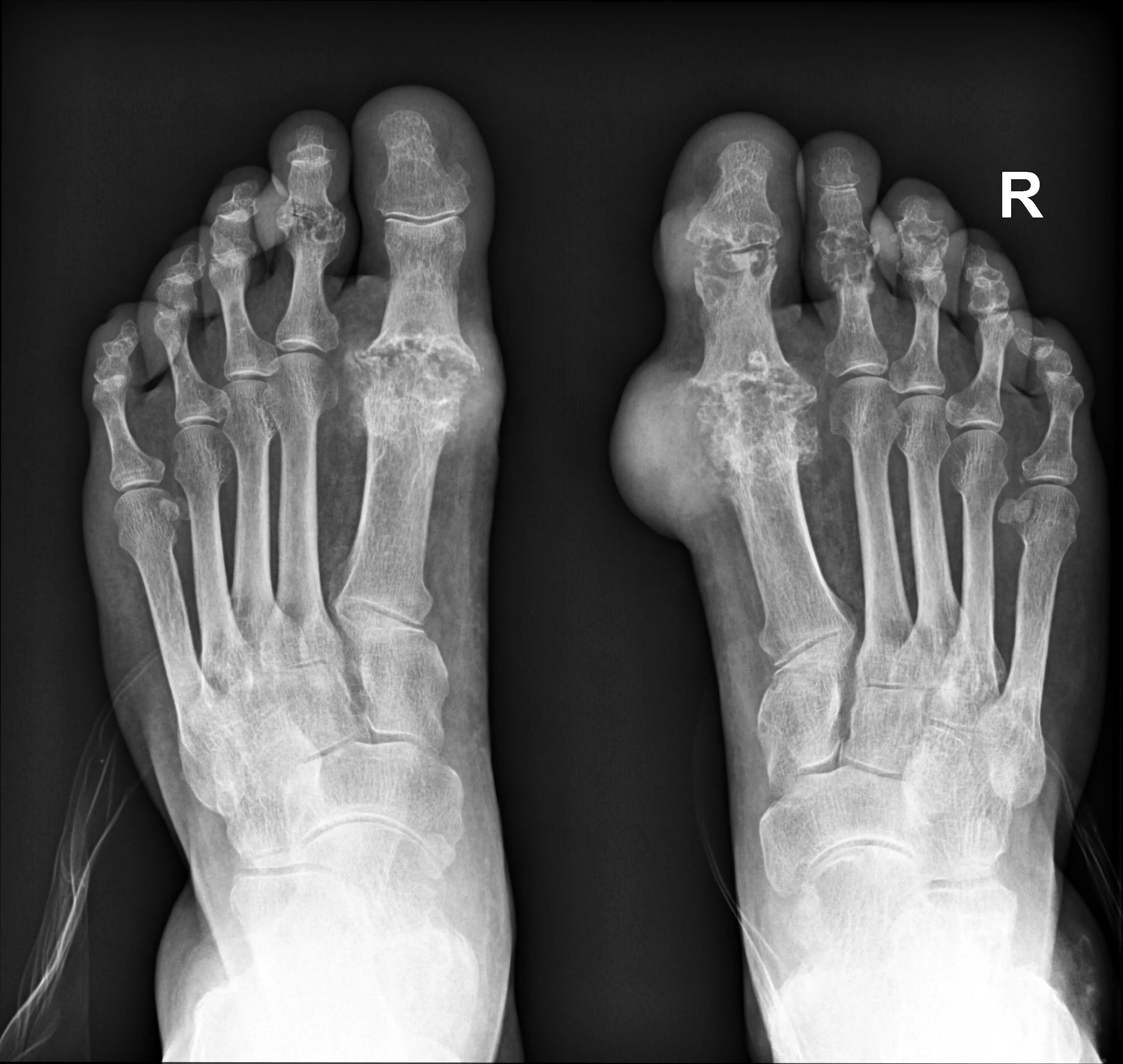 Подагрический артрит симптомы фото Image Radiopaedia.org