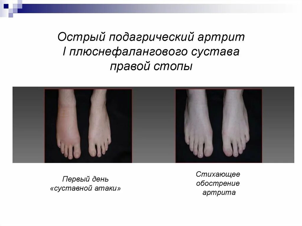 Подагрический артрит симптомы фото Подагра. Эпидемиология - презентация онлайн